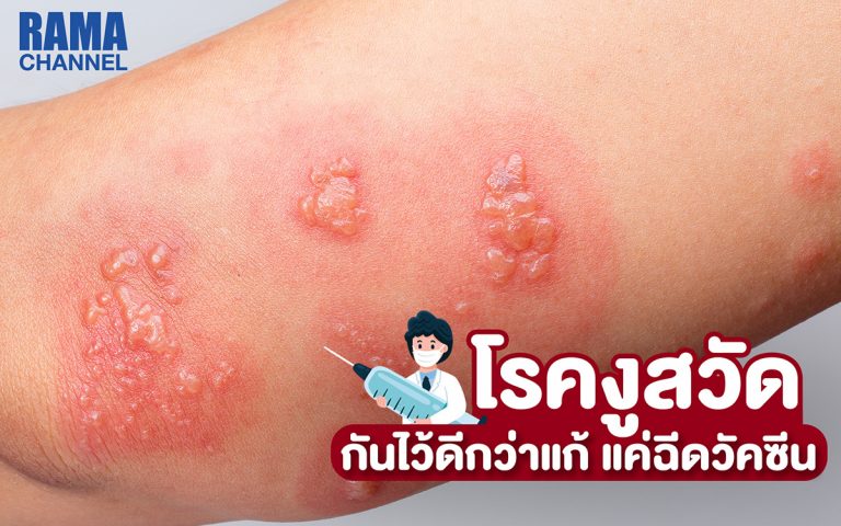 โรคงูสวัด กันไว้ดีกว่าแก้ แค่ฉีดวัคซีน