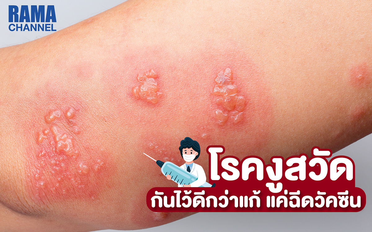 โรคงูสวัด กันไว้ดีกว่าแก้ แค่ฉีดวัคซีน