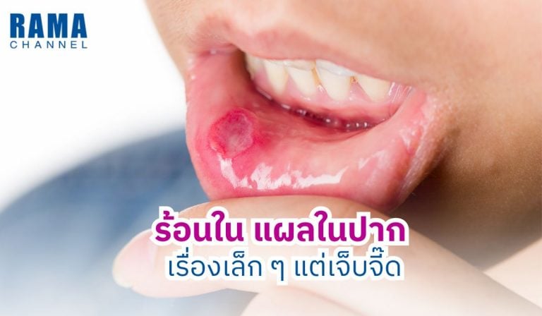 ร้อนใน แผลในปาก สาเหตุ อาการ และวิธีรักษาอย่างถูกวิธี