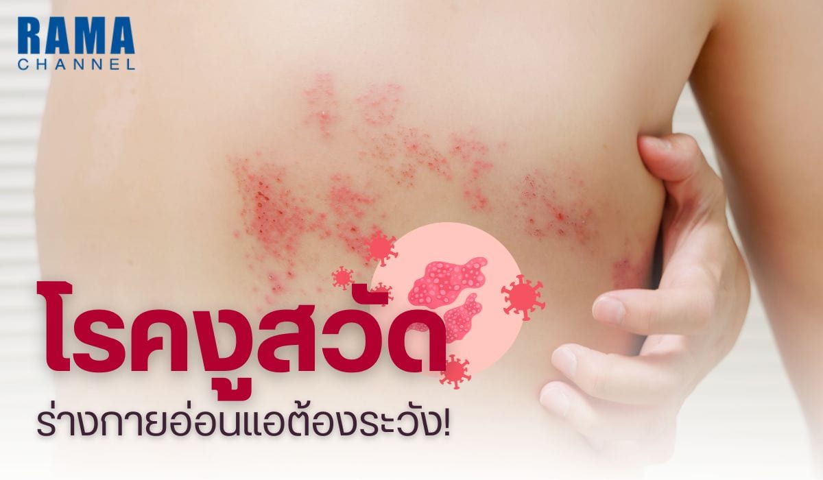 โรคงูสวัด ร่างกายอ่อนแอต้องระวัง