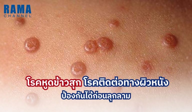 โรคหูดข้าวสุก โรคติดต่อทางผิวหนัง ป้องกัน ได้ก่อนลุกลาม
