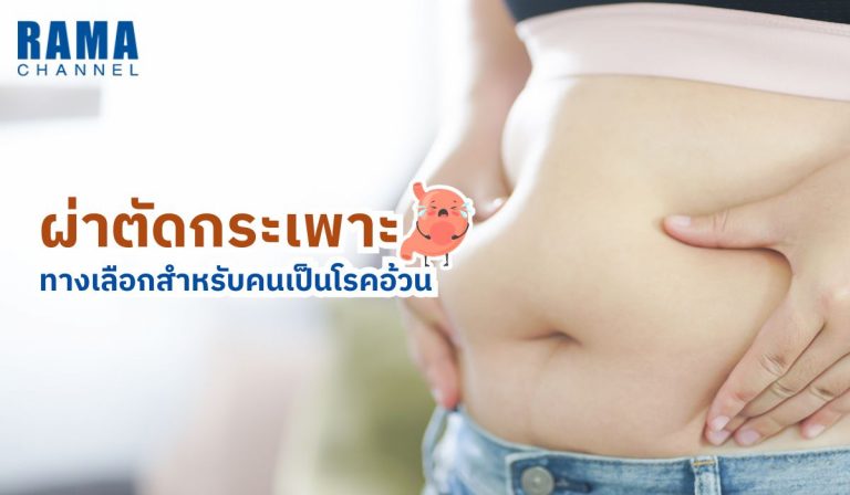 ผ่าตัดกระเพาะ ทางเลือกสำหรับคนเป็นโรคอ้วน