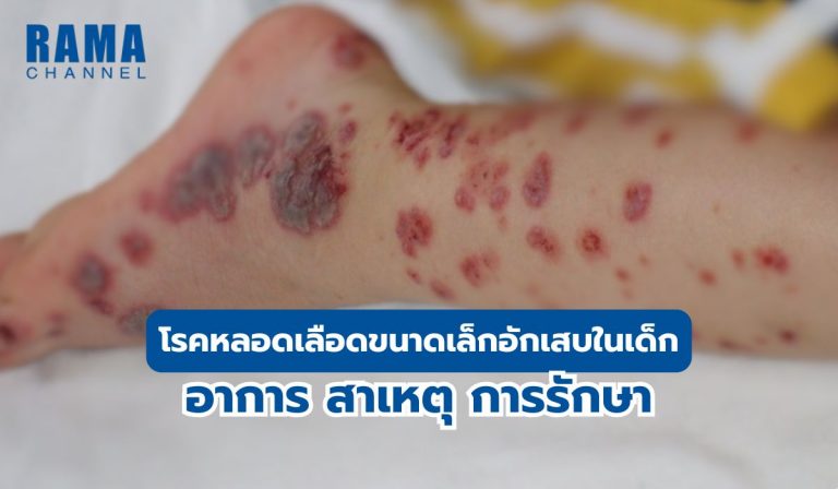 โรคเส้นเลือดอักเสบในเด็ก อาการ สาเหตุ การรักษา