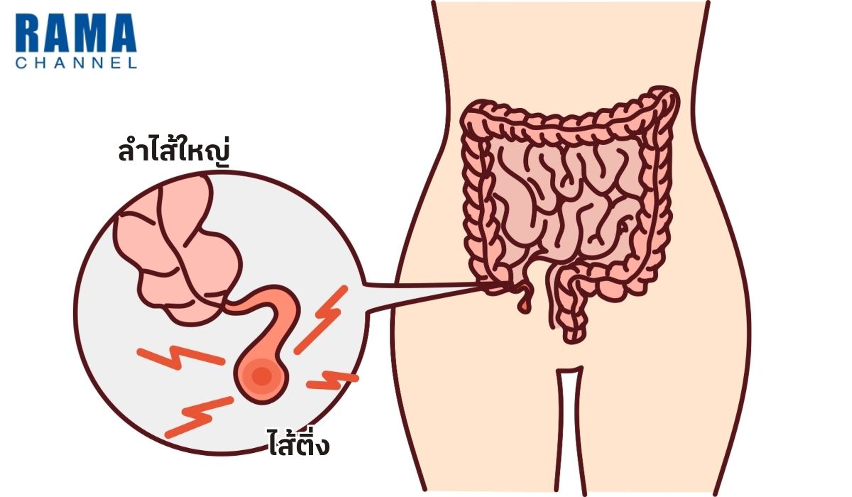 ไส้ติ่ง คืออะไร ?