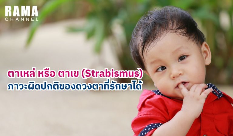 ตาเหล่​ หรือ ตาเข (Strabismus)​ ภาวะผิดปกติ​ของดวงตาที่​รักษา​ได้