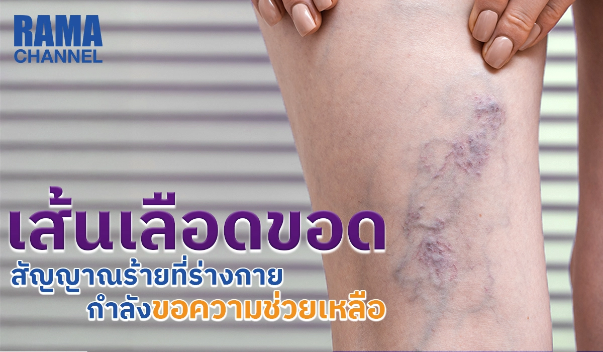 เส้นเลือดขอด สัญญาณร้ายที่ร่างกายกำลังขอความช่วยเหลือ