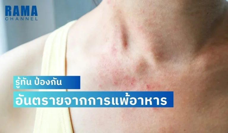 รู้ทัน ป้องกัน อันตรายจากการแพ้อาหาร