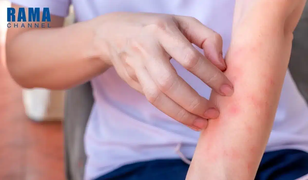 ผื่นแพ้เหงื่อ คืออะไร ?