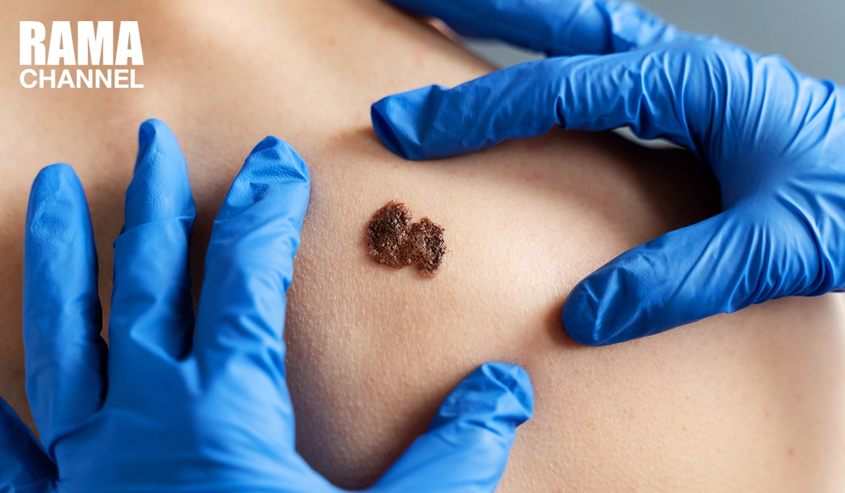 ปัจจัยเพิ่มความเสี่ยงมะเร็งผิวหนัง