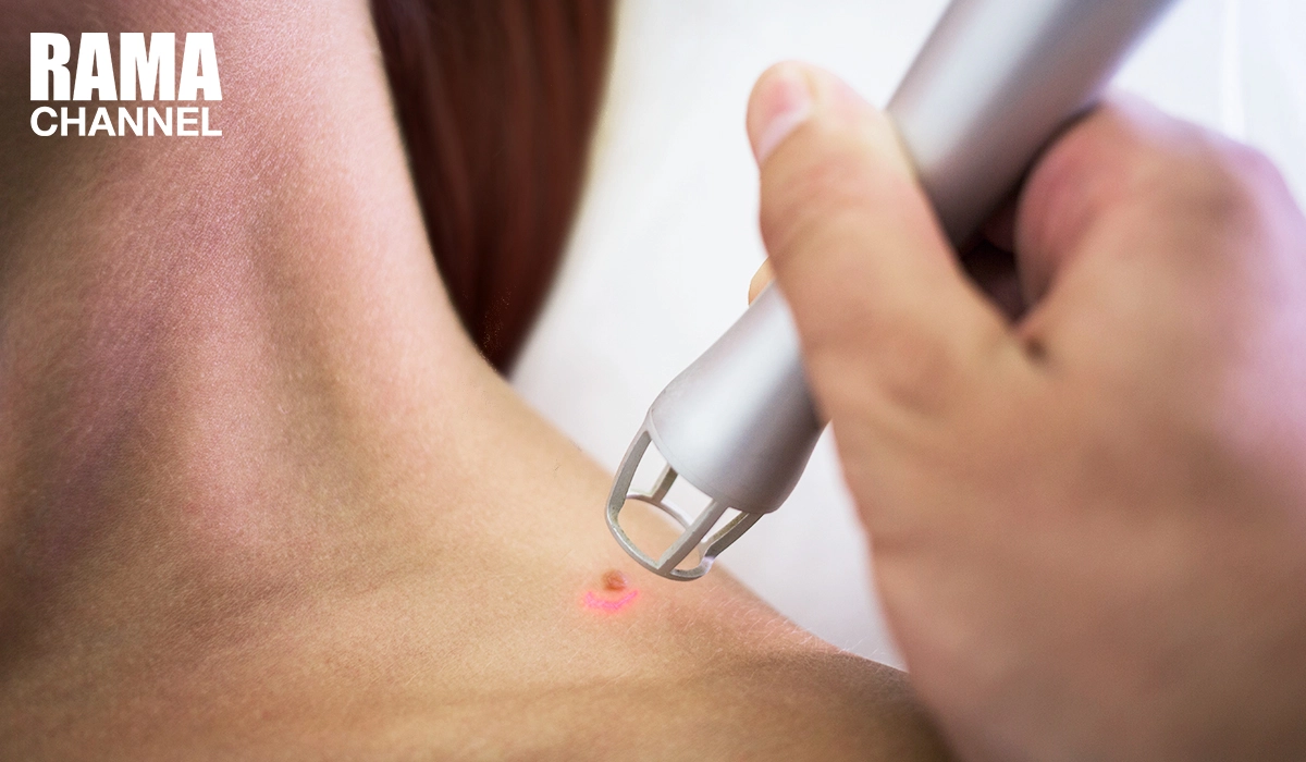 ปัจจัยเสี่ยงมะเร็งผิวหนัง