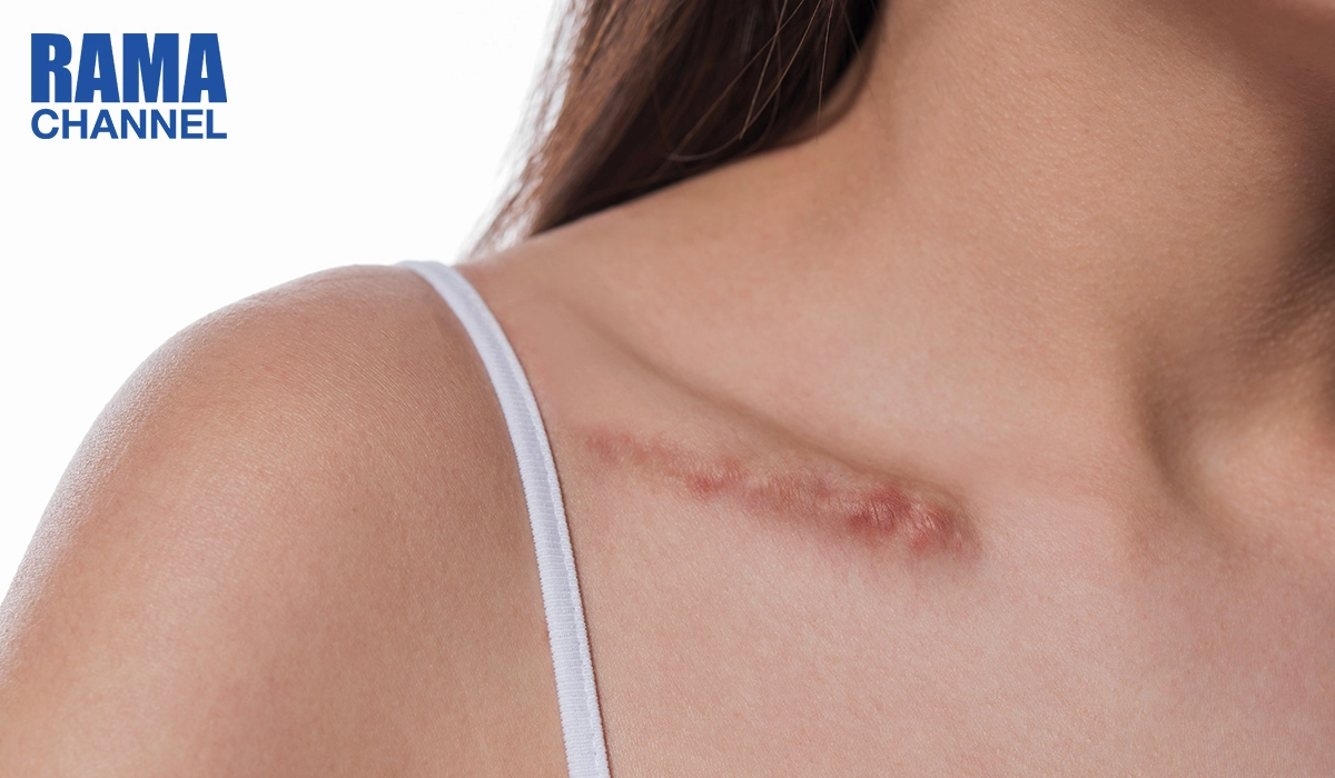 หลีกเลี่ยงการแกะเกาแผล