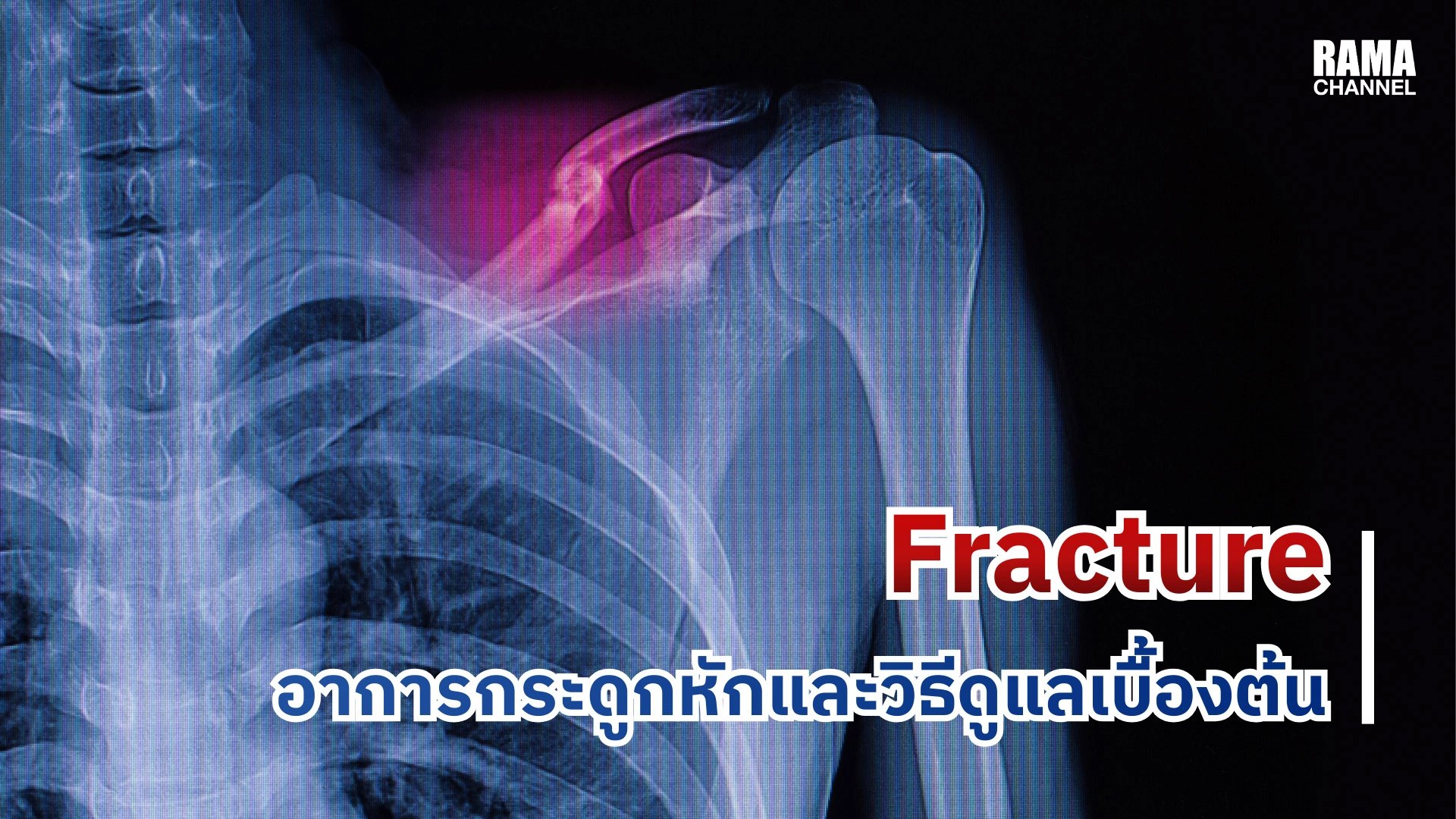 Fracture กระดูกหัก
