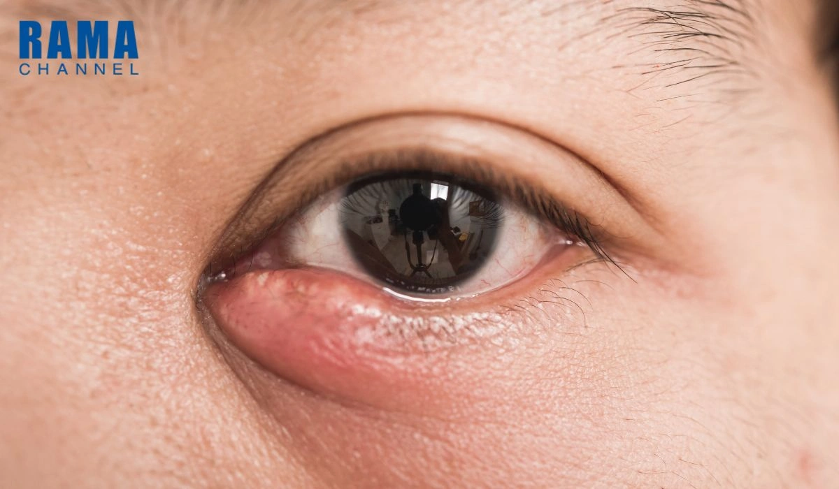 ตากุ้งยิง คืออะไร ?