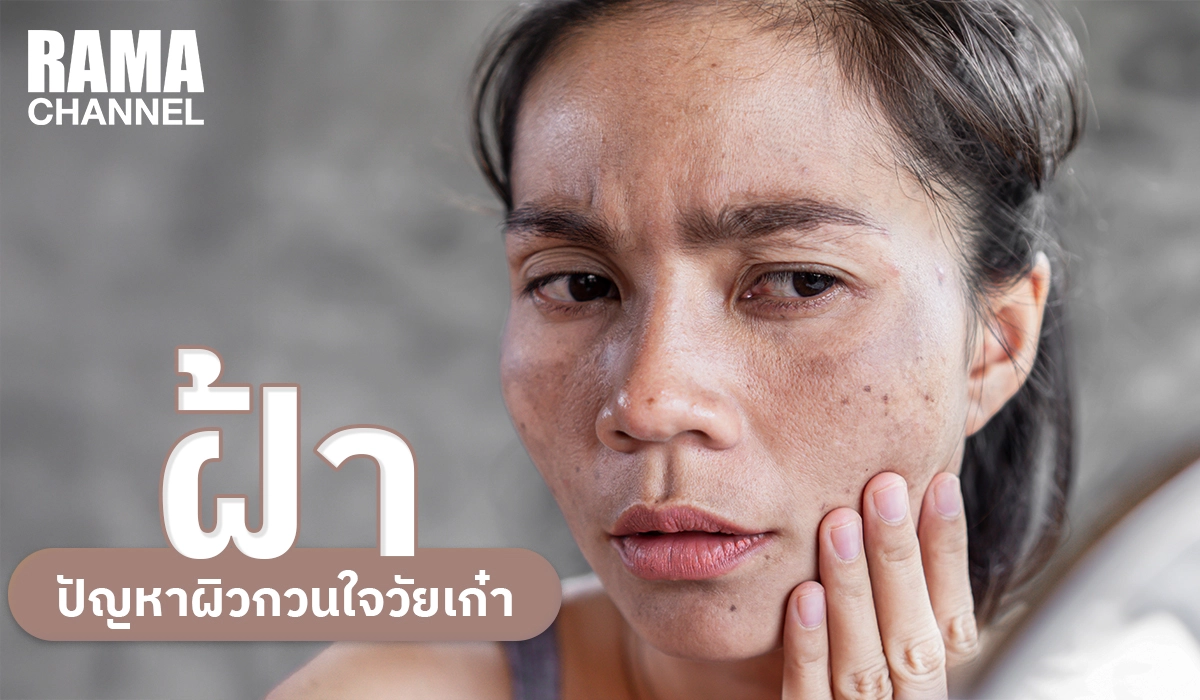 ฝ้า ปัญหาผิวกวนใจวัยเก๋า