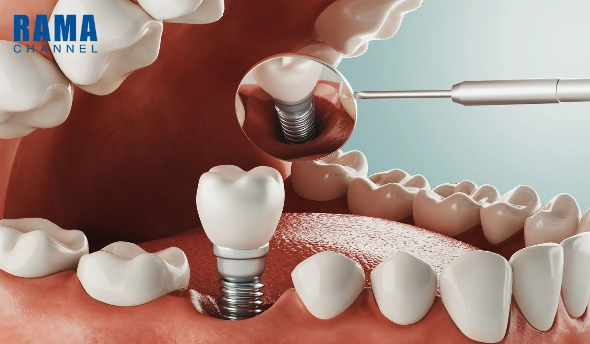 รากฟันเทียม คืออะไร ?