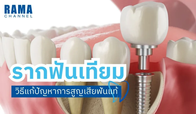 รากฟันเทียม วิธีแก้ปัญหาการสูญเสียฟันแท้