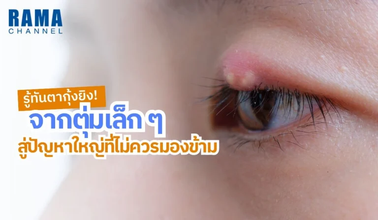 รู้ทันตากุ้งยิง! จากตุ่มเล็ก ๆ สู่ปัญหาใหญ่ที่ไม่ควรมองข้าม