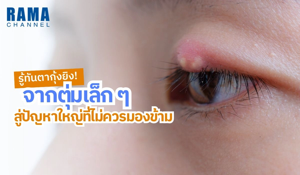 รู้ทันตากุ้งยิง! จากตุ่มเล็ก ๆ สู่ปัญหาใหญ่ที่ไม่ควรมองข้าม