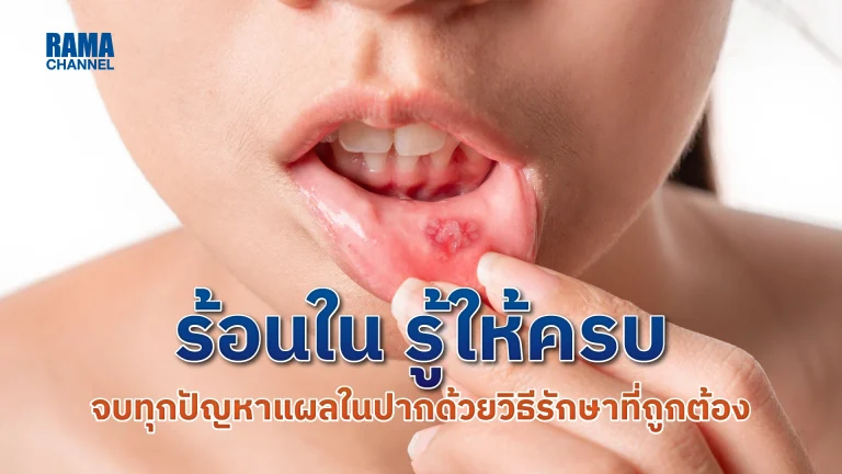 ร้อนใน รู้ให้ครบ จบทุกปัญหาแผลในปากด้วยวิธีรักษาที่ถูกต้อง