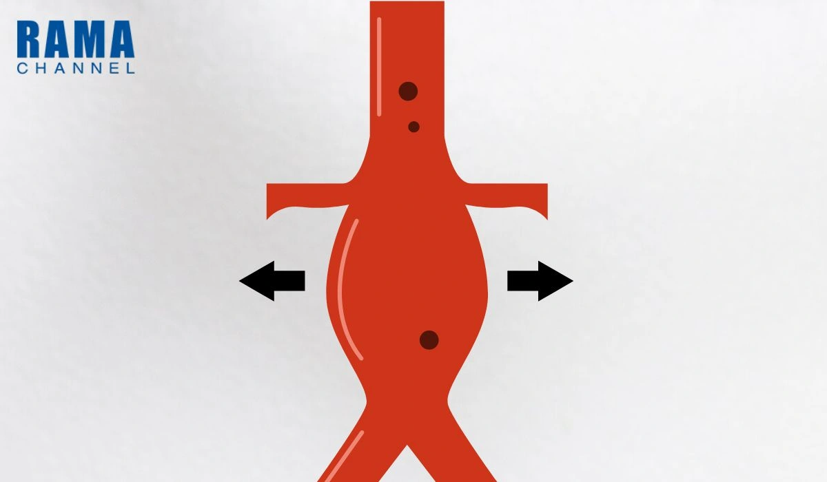 โรคหลอดเลือดแดงใหญ่โป่งพอง คืออะไร