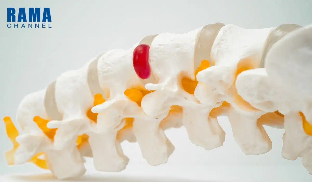 หมอนรองกระดูกทับเส้นประสาท คืออะไร ?