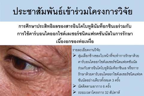 ประชาสัมพันธ์เข้าร่วมโครงการวิจัยการศึกษาประสิทธิผลของสารอินโคโบทูลินัมท็อกซินเอร่วมกับการใช้คาร์บอนไดออกไซด์เลเซอร์ชนิดแฟรคชันนัลในการรักษาเนื้องอกของท่อเหงื่อ