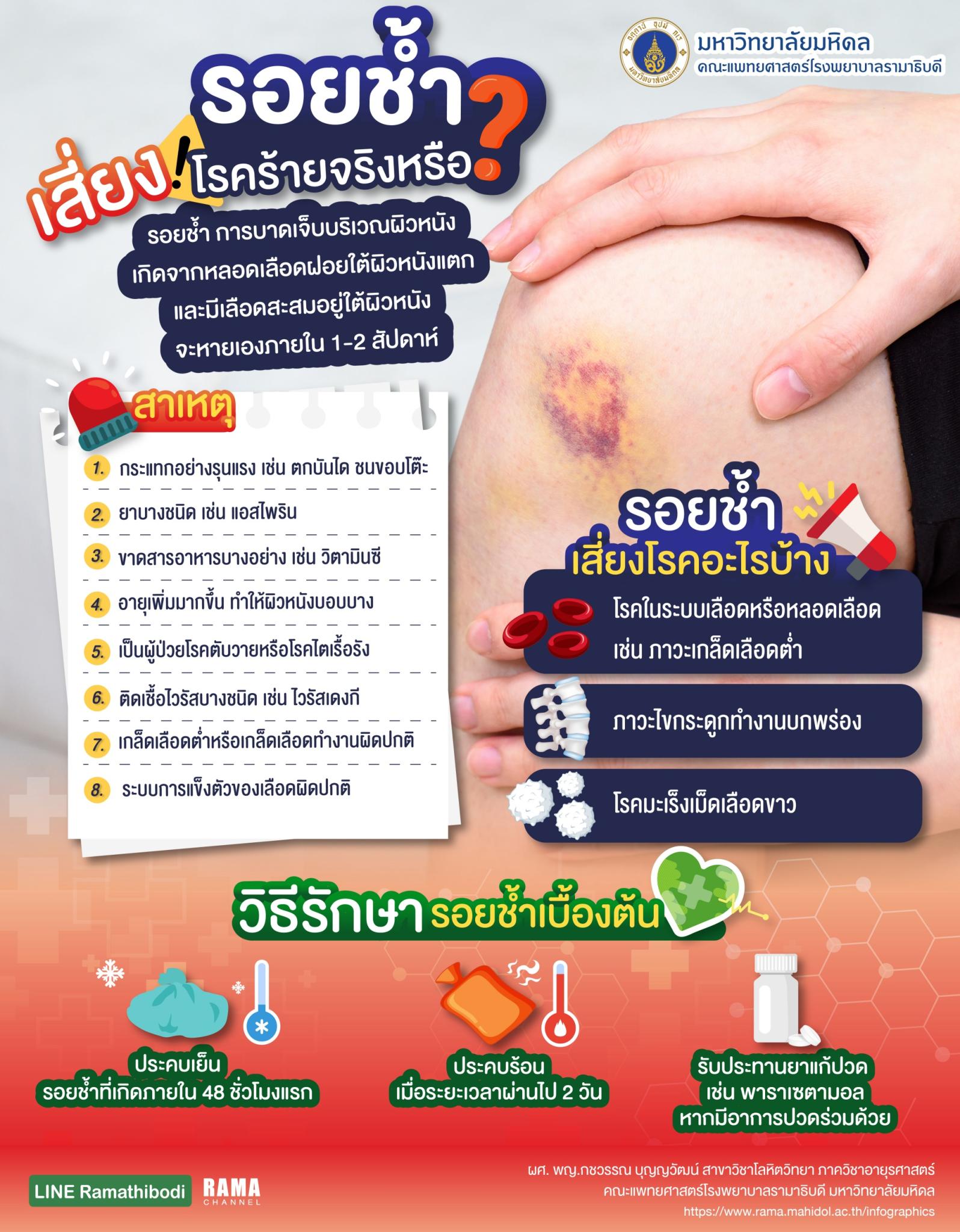 รอยช้ำ เสี่ยงโรคร้ายจริงหรือ ?