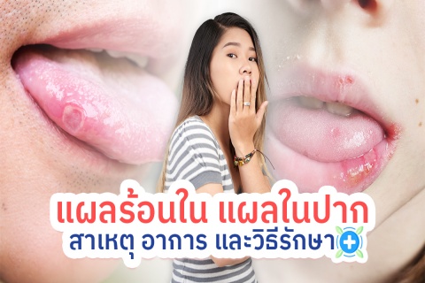 แผลร้อนใน แผลในปาก