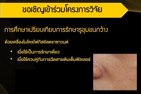 ขอเชิญร่วมโครงการวิจัย การศึกษาเปรียบเทียบการรักษารูขุมขนกว้าง