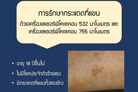 ขอเชิญเข้าร่วมโครงการวิจัย การรักษากระแดดที่แขน ด้วยเครื่องเลเซอร์พิโคเซคอน 532 นาโนเมตร และเครื่องเลเซอร์พิโคเซคอน 755 นาโนเมตร