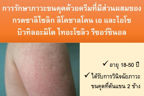 ขอเชิญเข้าร่วมโครงการวิจัย การรักษาภาวะขนคุดด้วยครีมที่มีส่วนผสมของกรดซาลิไซลิก ลิโคซาลโคน เอ และไอโซบิวทิลอะมิโด ไทอะโซลิว รีซอร์ซินอล