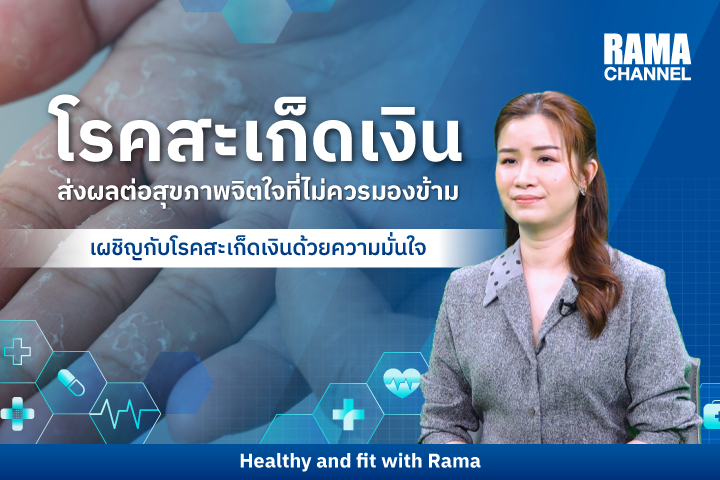 เผชิญกับ โรคสะเก็ดเงิน ด้วยความมั่นใจ