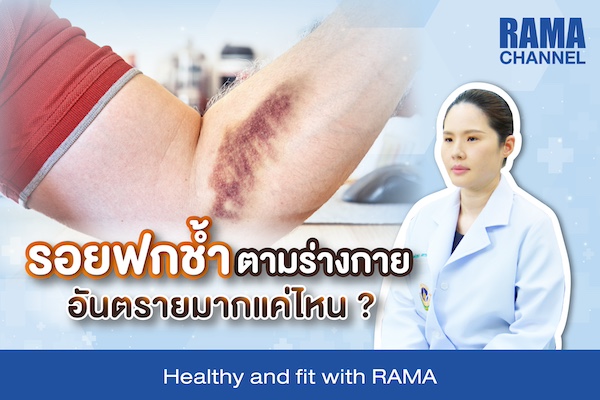 รอยฟกช้ำตามร่างกาย อันตรายมากแค่ไหน ?