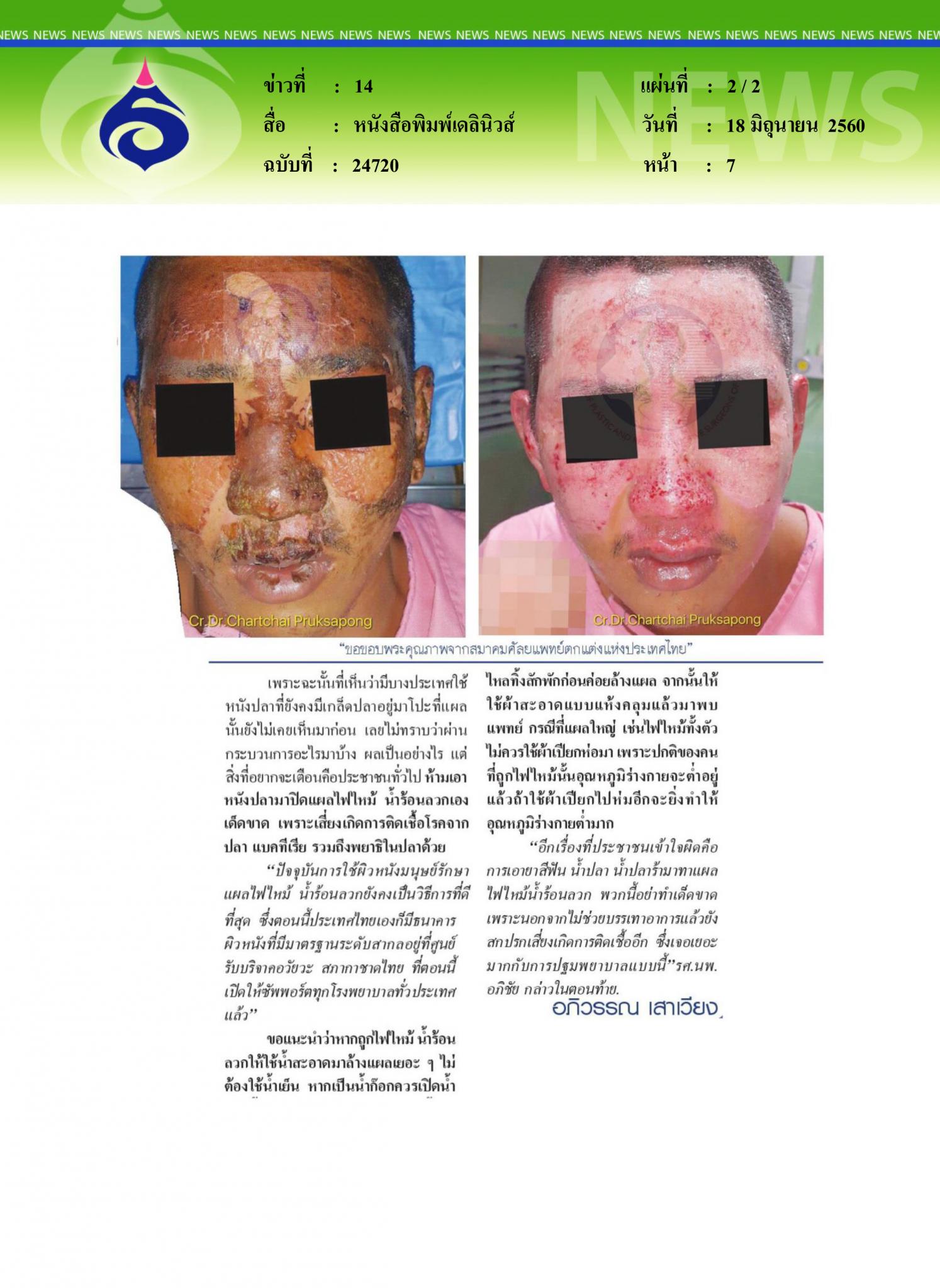 หนังสือพิมพ์เดลินิวส์, หนังปลารักษาแผลไฟไหม้ได้จริงหรือ