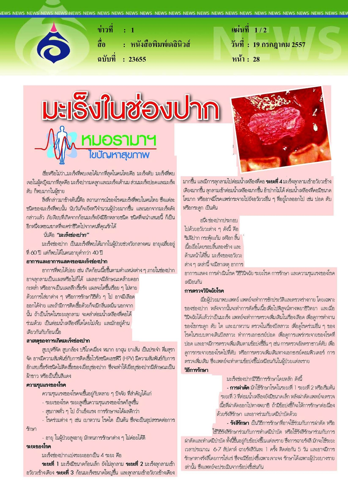 เดลินิวส์ : มะเร็งในช่องปาก