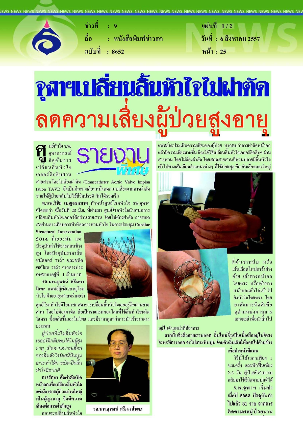 ข่าวสด : จุฬาฯ เปลี่ยนลิ้นหัวใจไม่ผ่าตัดลดความเสี่ยงผู้ป่วยสูงอายุ