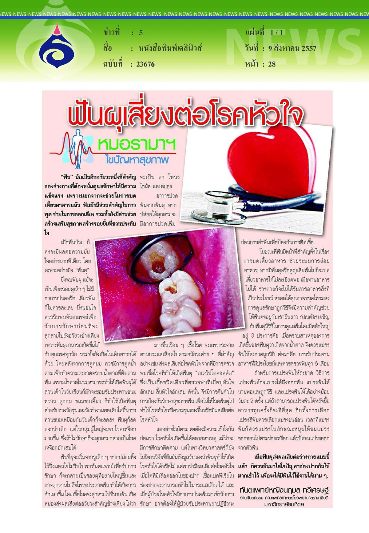 ึเดลินิวส์ : ฟันผุเสี่ยงต่อโรคหัวใจ