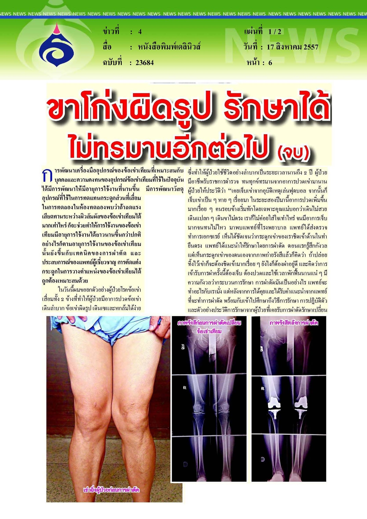 เดลินิวส์ : ขาโก่งผิดรูป รักษาได้ ไม่ทรมานอีกต่อไป ตอบ จบ
