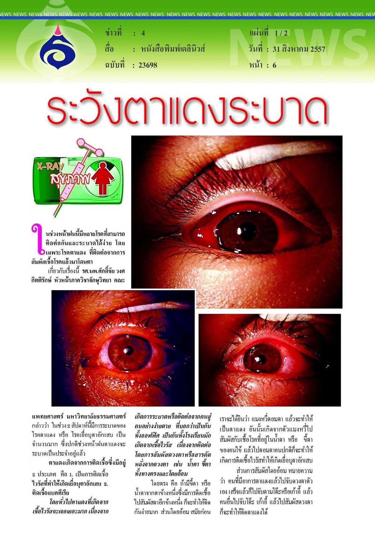 เดลนิวส์ : ระวังตาแดงระบาด