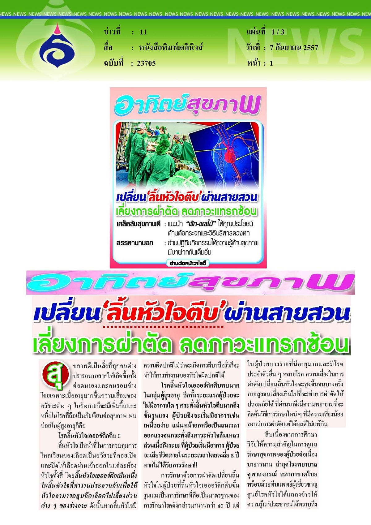 เดลินิวส์ : เปลี่ยนลิ้นหัวใจตีบผ่านสายสวน