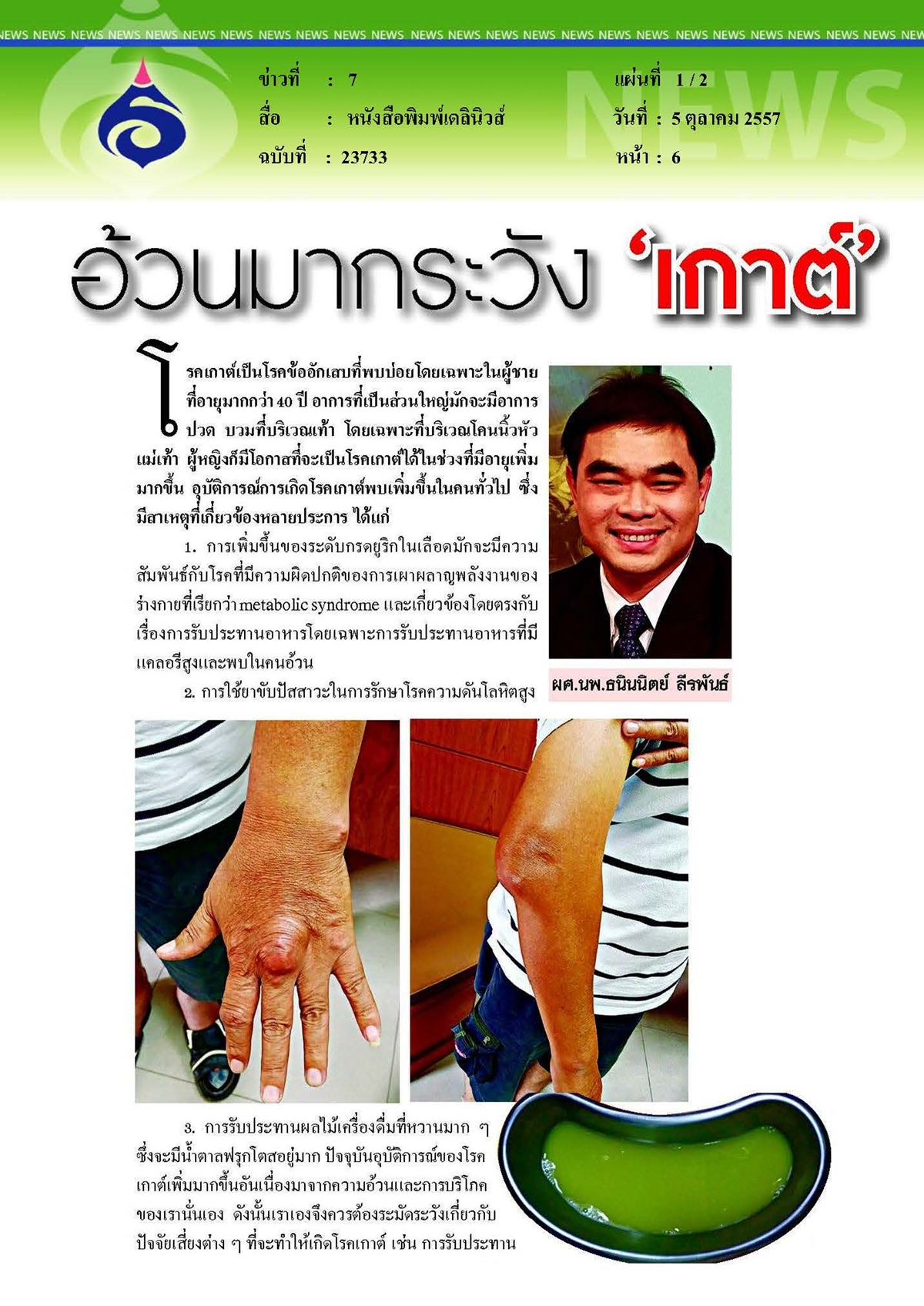 เดลินิวส์ : อ้วนมากระวังเกาต์