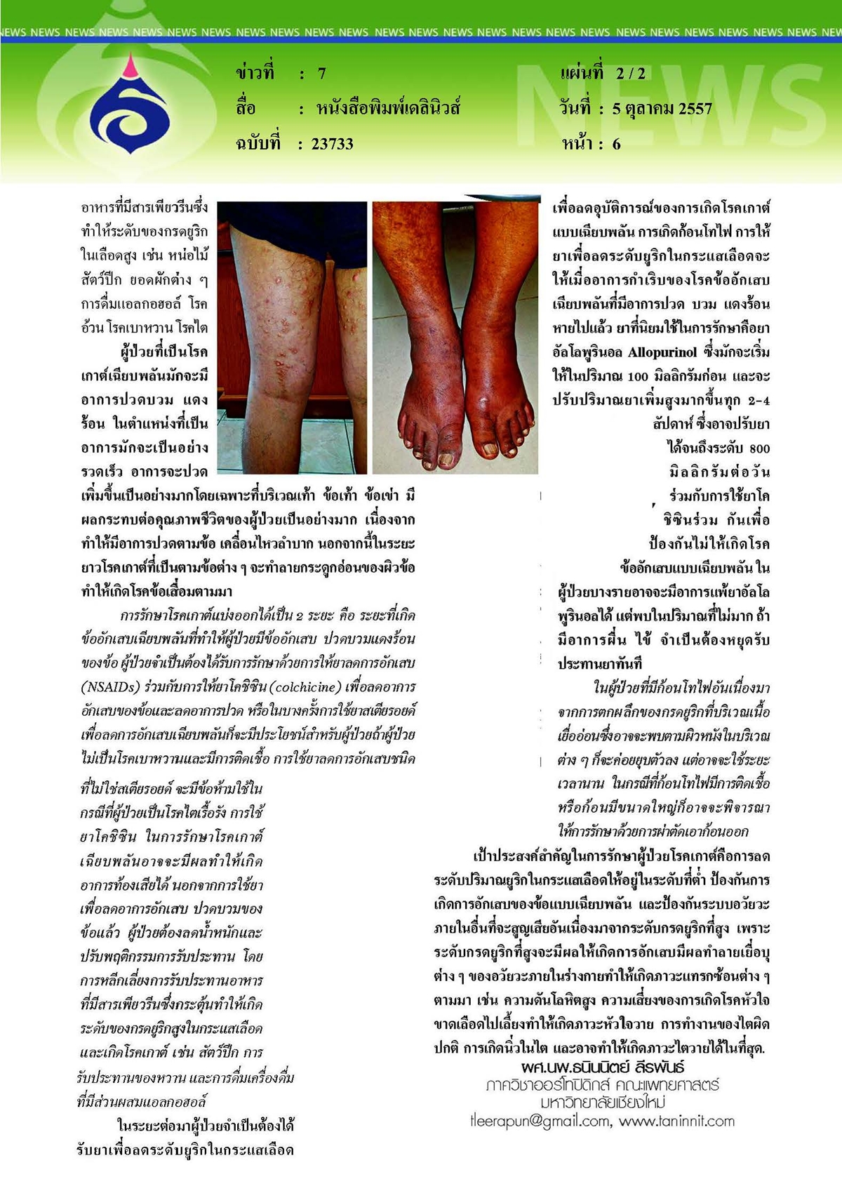 เดลินิวส์ : อ้วนมากระวังเกาต์