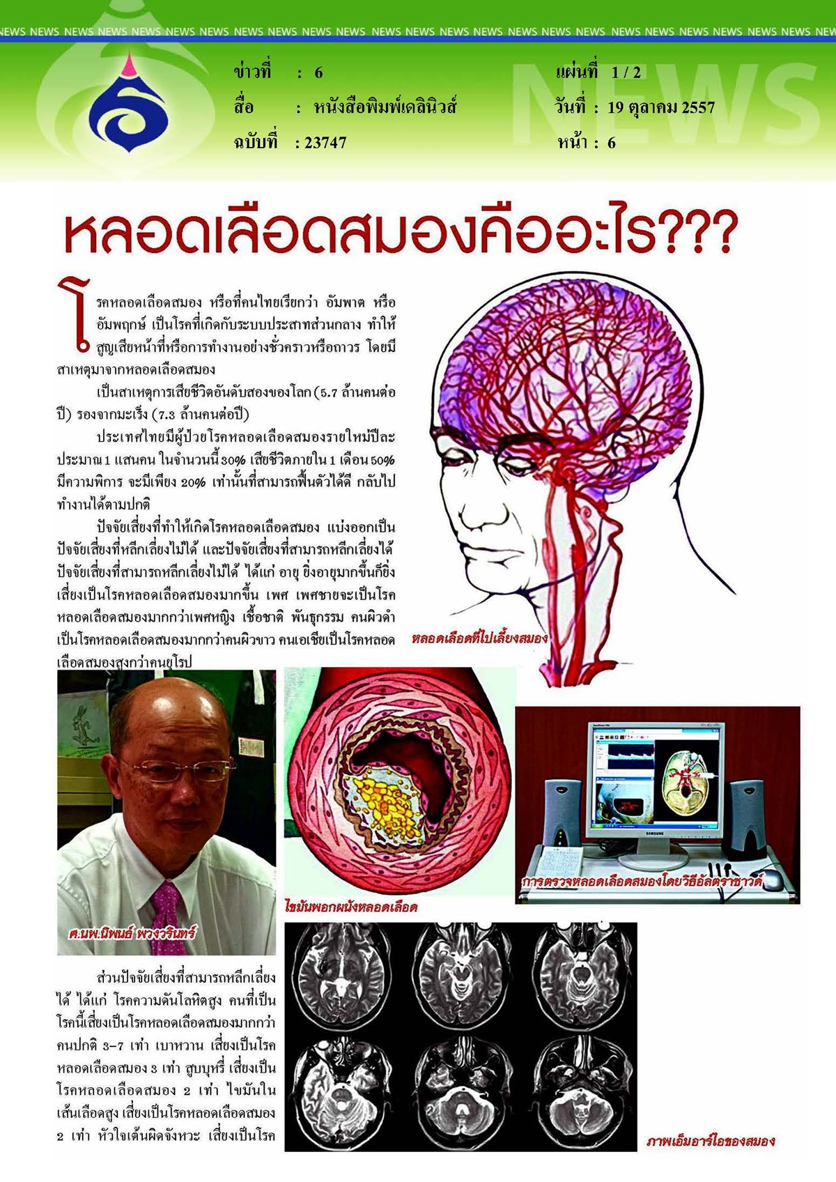 เดลินิวส์ : หลอดเลือดสมองคืออะไร