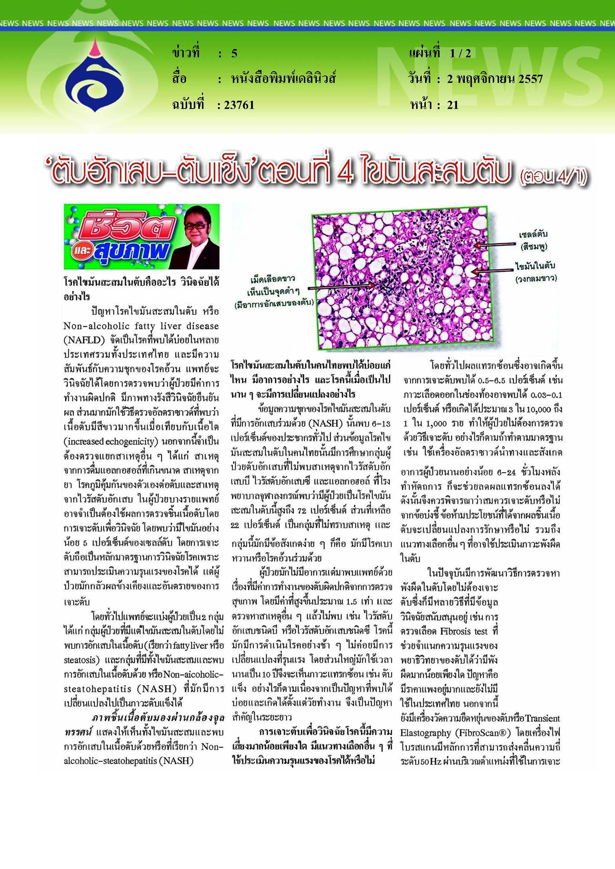 เดลินิวส์ : ตับอักเสบและตับแข็ง ตอนที่ 4 ไขมันสะสมตับ