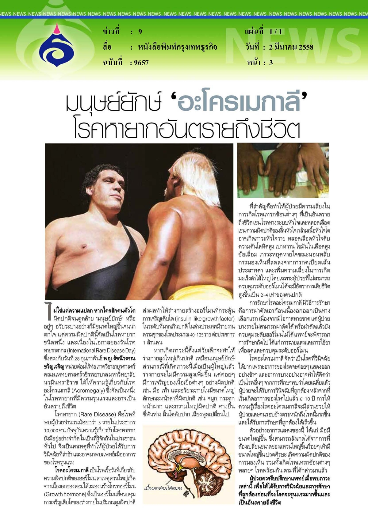 กรุงเทพธุรกิจ : อะโครเมกาลี...โรคหายากอันตรายถึงชีวิต
