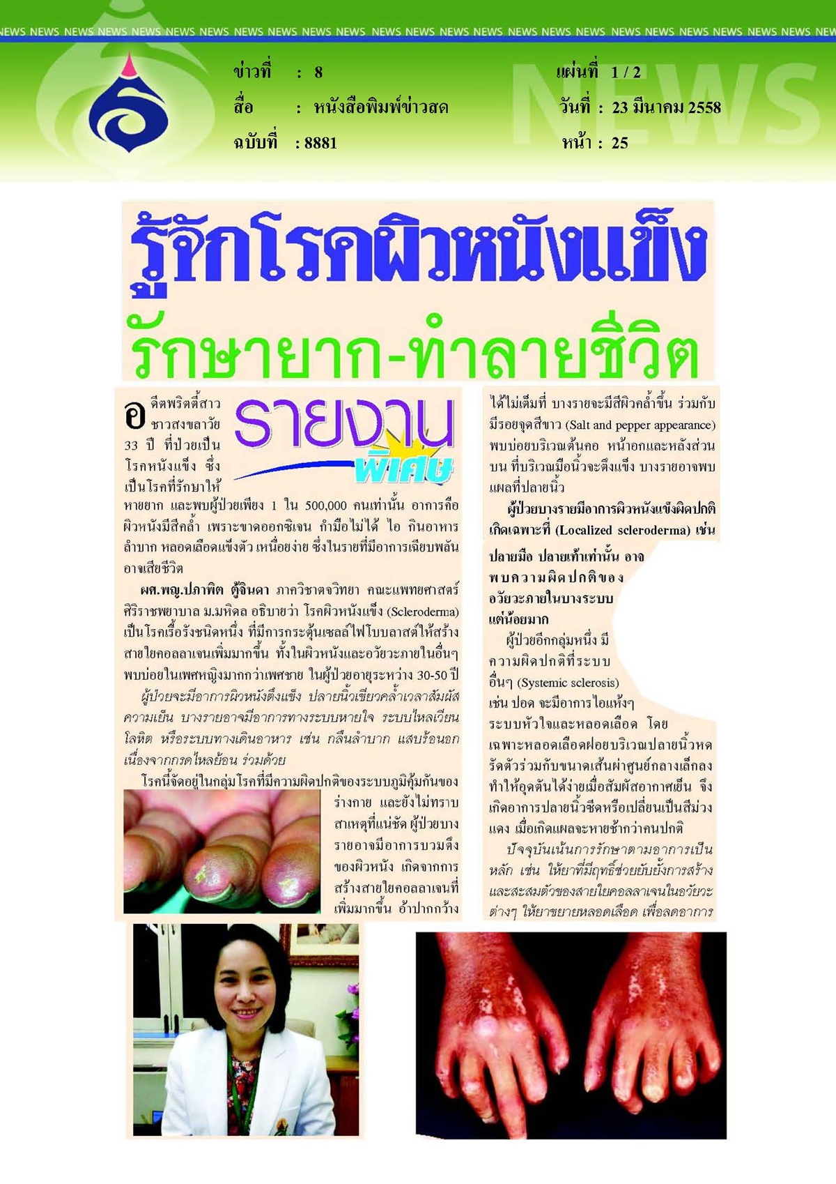 ข่าวสด : รู้จักโรคผิวหนังแข็งรักษายาก... ทำลายชีวิต