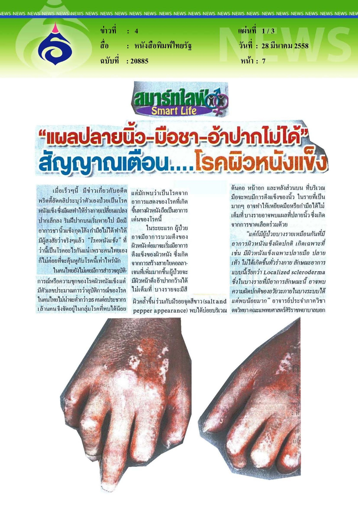 ไทยรัฐ : สัญญาณเตือน...โรคผิวหนังแข็ง