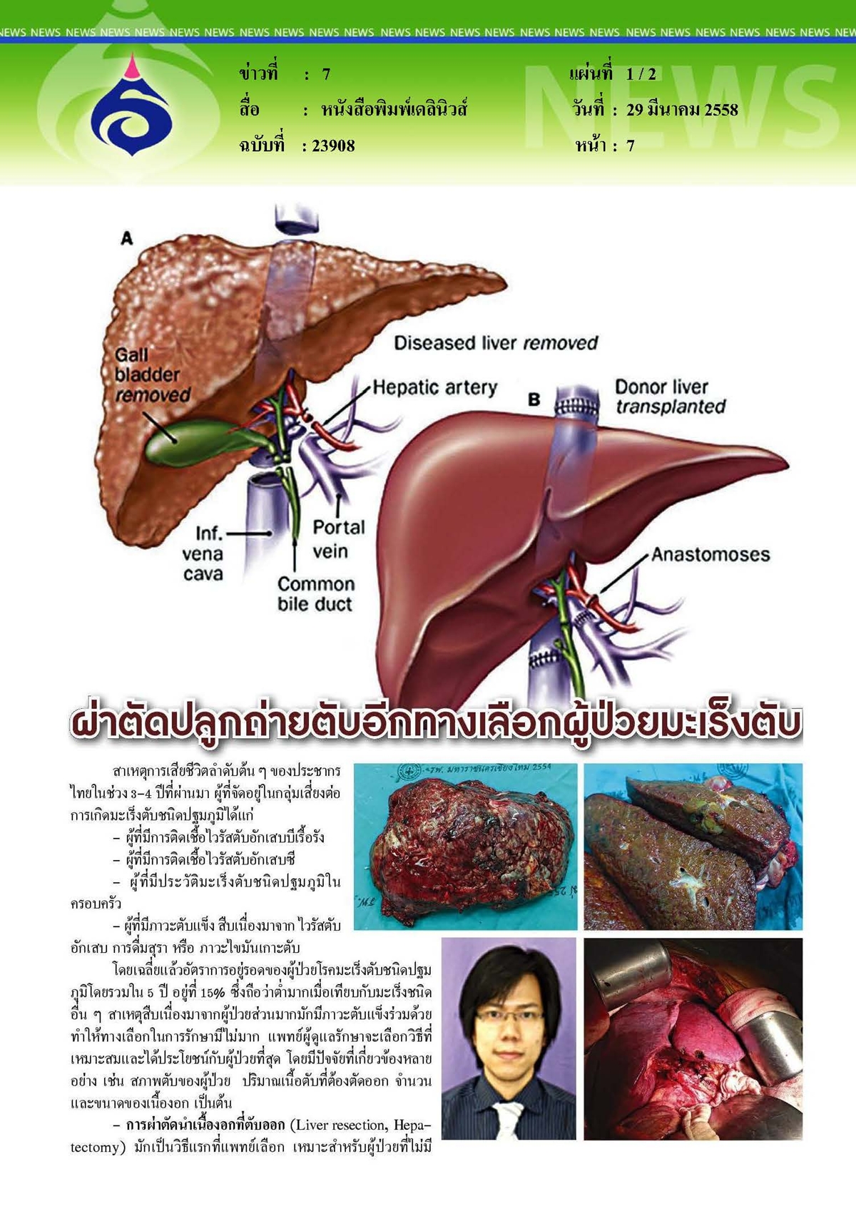 เดลินิวส์ : ผ่าตัดปลูกถ่ายตับอีกทางเลือกผู้ป่วยมะเร็งตับ