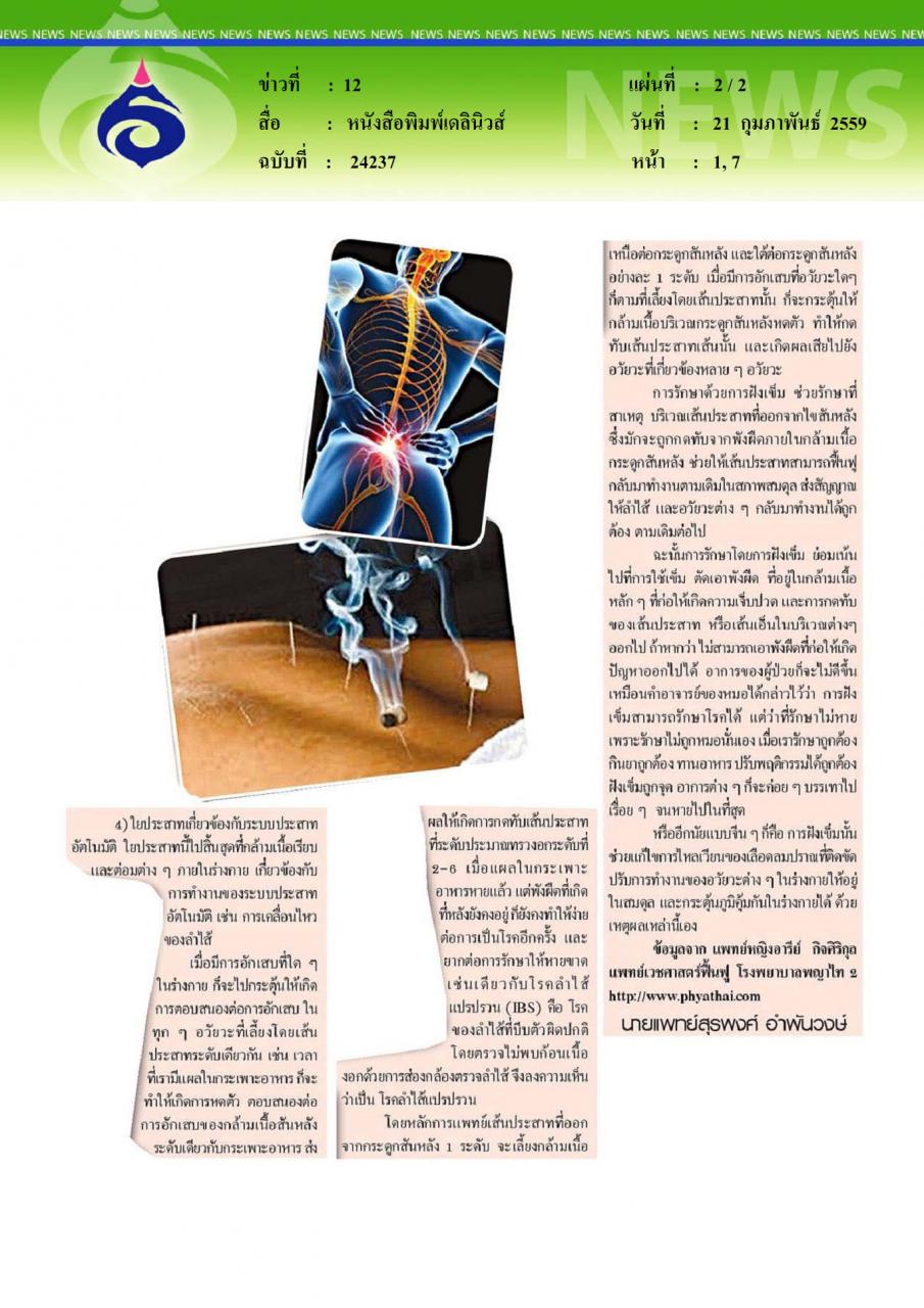 หนังสือพิมพ์เดลินิวส์ การฝังเข็มรักษาโรคลำไส้แปรปรวน