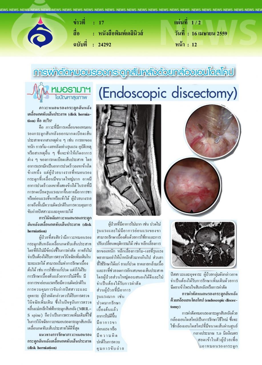 หนังสือพิมพ์เดลินิวส์ หมอรามาฯไขปัญหาสุขภาพ ตอน การผ่าตัดหมอนรองกระดูกสันหลังด้วยกล้องเอนโดสโคป...